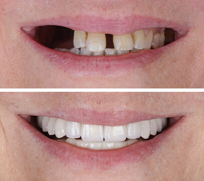 Illustrative before and after example of a full smile restoration with crowns